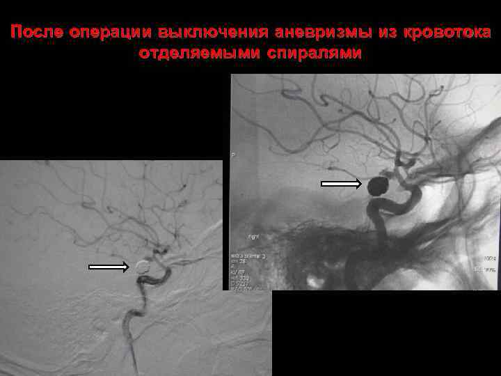 После операции выключения аневризмы из кровотока отделяемыми спиралями 