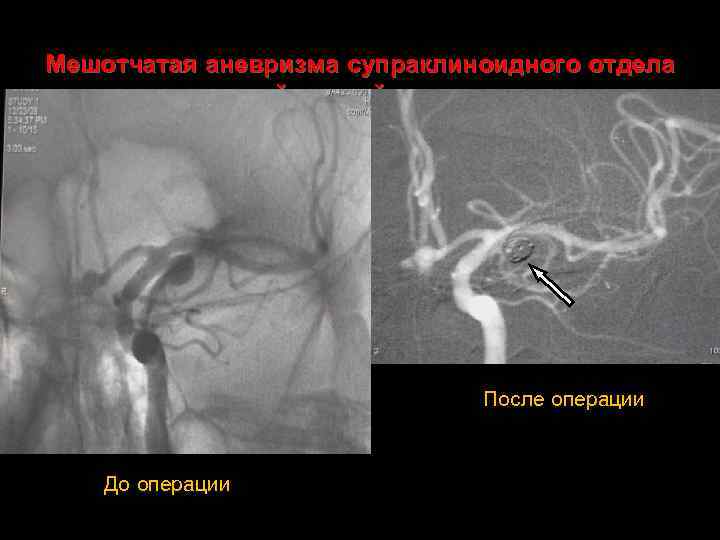 Мешотчатая аневризма супраклиноидного отдела внутренней сонной артерии слева После операции До операции 