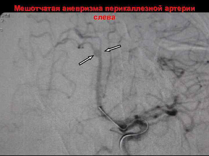 Мешотчатая аневризма перикаллезной артерии слева 