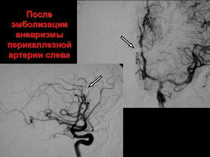 После эмболизации аневризмы перикаллезной артерии слева 