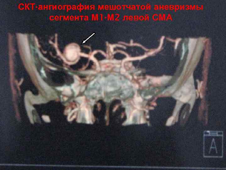 СКТ-ангиография мешотчатой аневризмы сегмента М 1 -М 2 левой СМА 