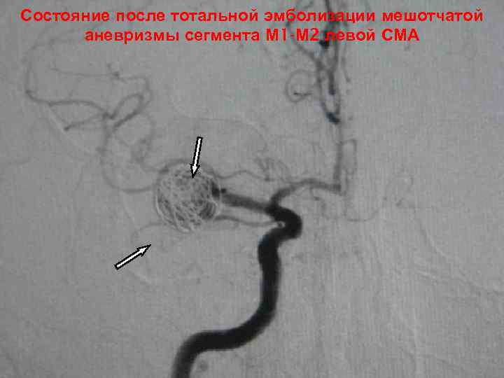 Состояние после тотальной эмболизации мешотчатой аневризмы сегмента М 1 -М 2 левой СМА 