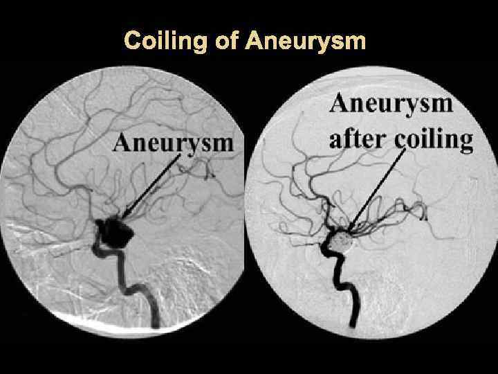 Coiling of Aneurysm 