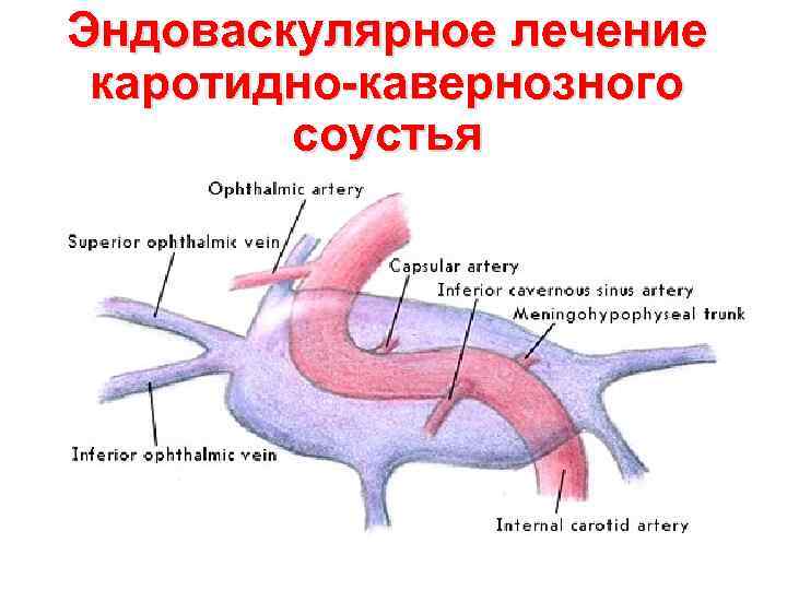 Эндоваскулярное лечение каротидно-кавернозного соустья 