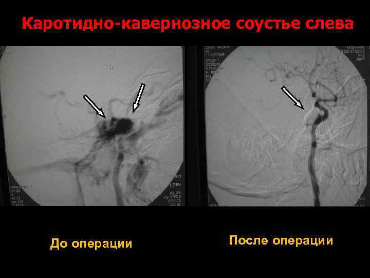 Каротидно-кавернозное соустье слева До операции После операции 