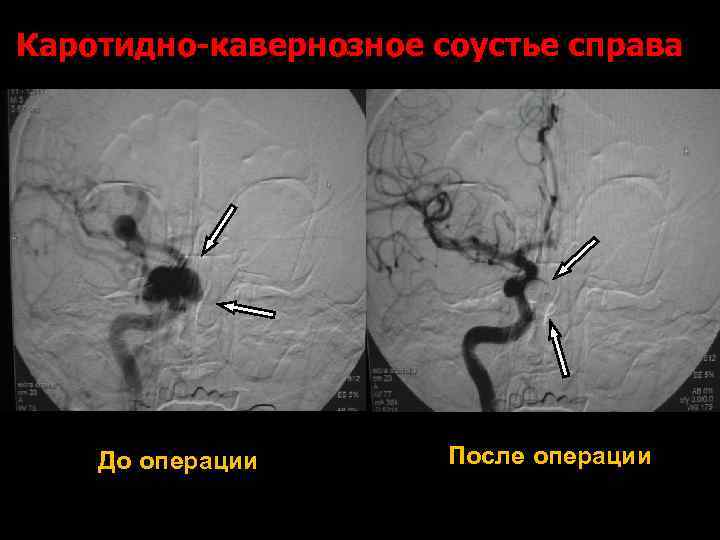 Каротидно-кавернозное соустье справа До операции После операции 