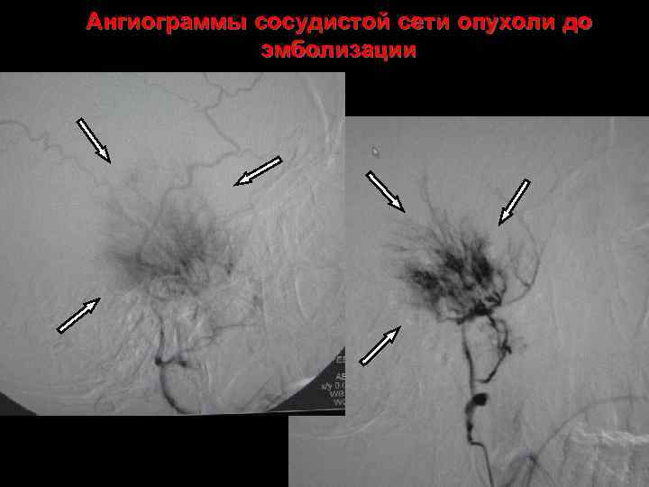 Ангиограммы сосудистой сети опухоли до эмболизации 