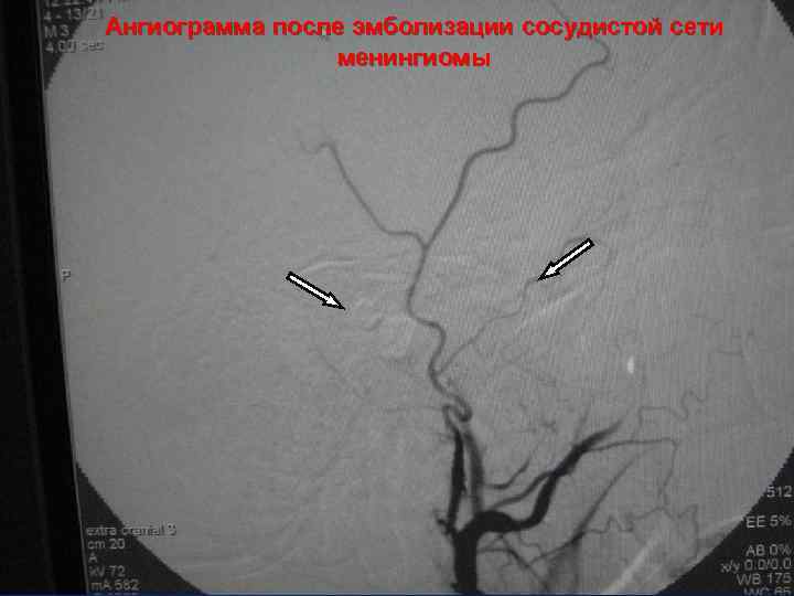 Ангиограмма после эмболизации сосудистой сети менингиомы 