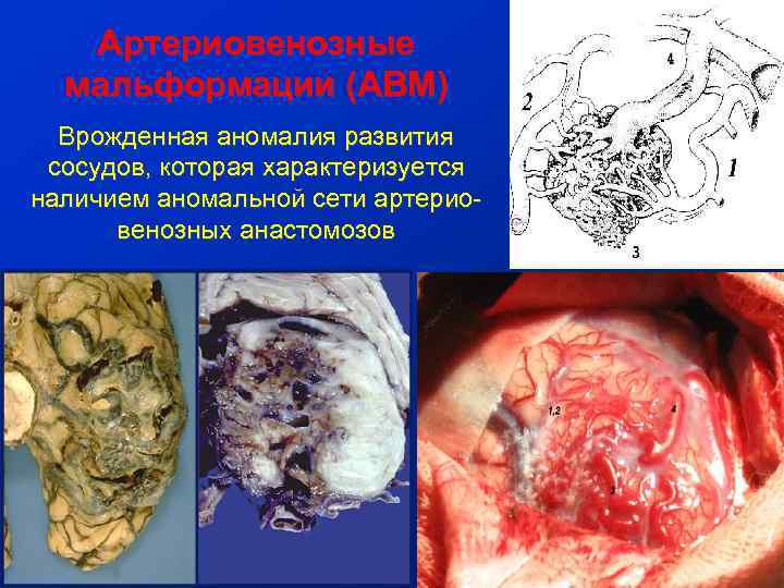 Артериовенозные мальформации (АВМ) Врожденная аномалия развития сосудов, которая характеризуется наличием аномальной сети артериовенозных анастомозов