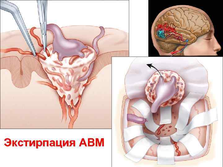 Экстирпация АВМ 