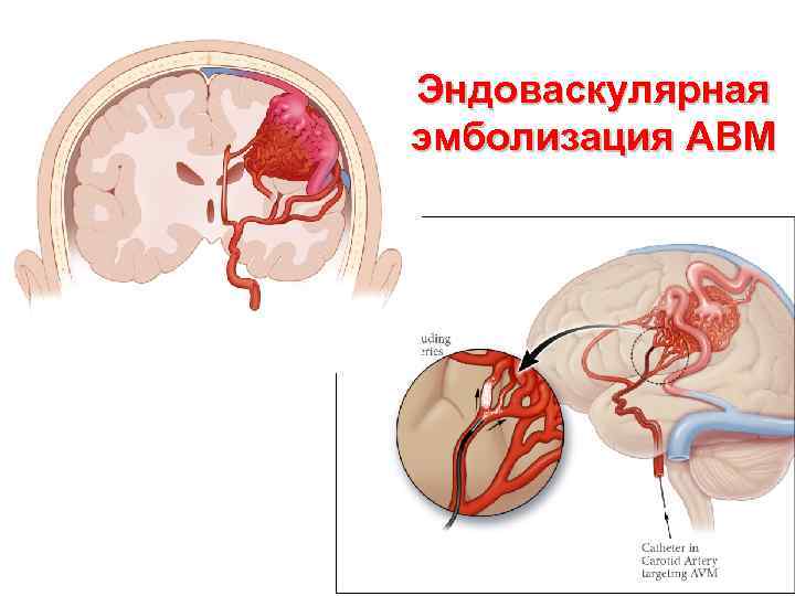 Эндоваскулярная эмболизация АВМ 