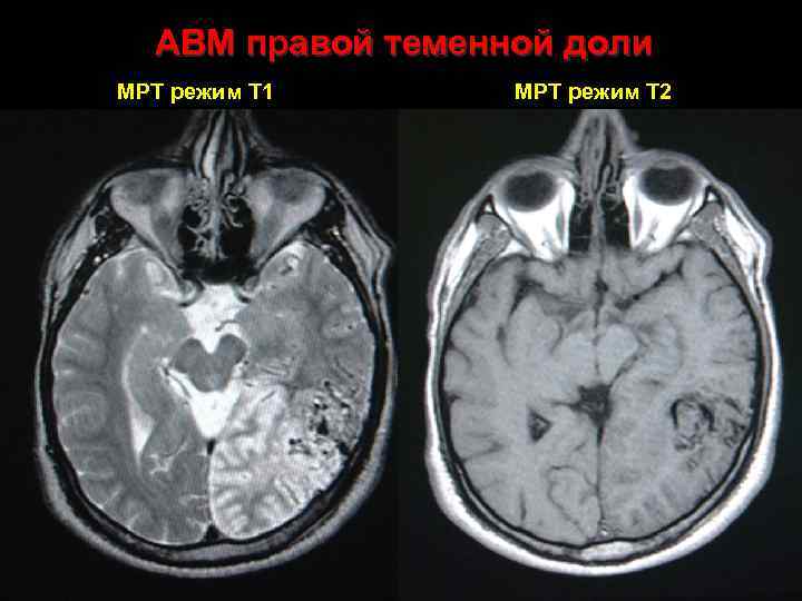 АВМ правой теменной доли МРТ режим Т 1 МРТ режим Т 2 