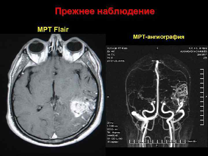 Прежнее наблюдение МРТ Flair МРТ-ангиография 