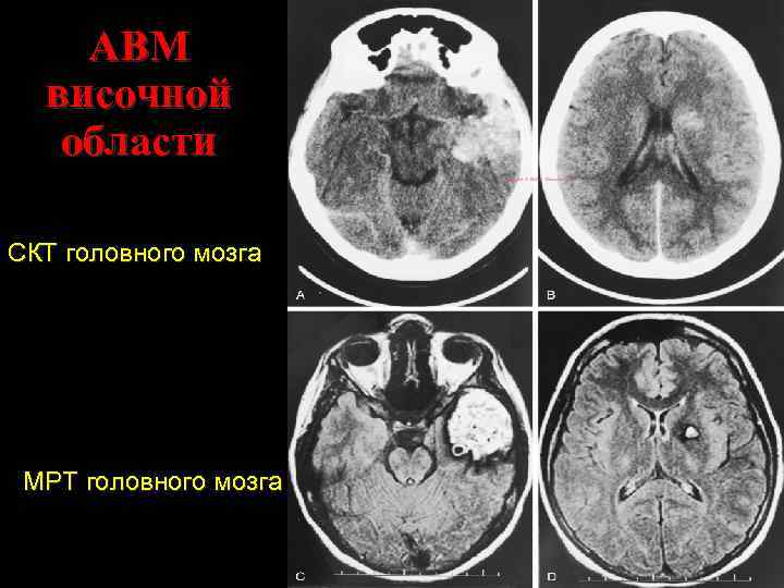 АВМ височной области СКТ головного мозга МРТ головного мозга 