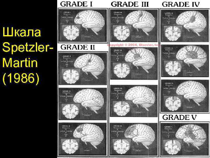 Шкала Spetzler. Martin (1986) 