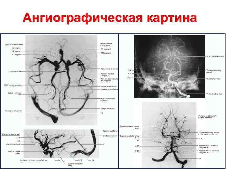 Ангиографическая картина 