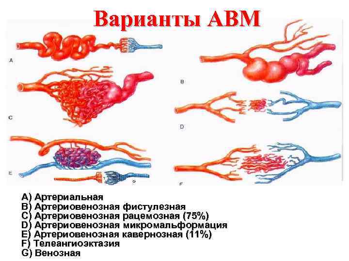 Варианты АВМ А) Артериальная В) Артериовенозная фистулезная С) Артериовенозная рацемозная (75%) D) Артериовенозная микромальформация