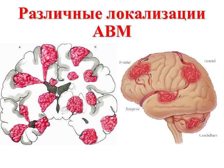 Различные локализации АВМ 