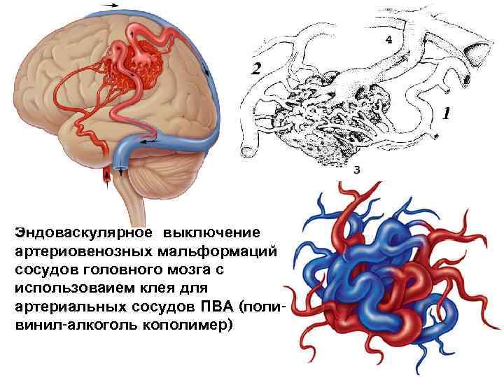 Лечение венозной мальформации