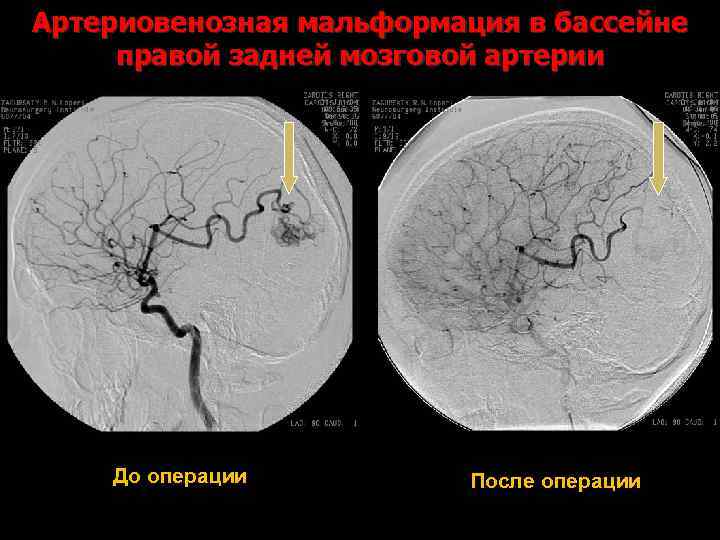 Артериовенозная мальформация в бассейне правой задней мозговой артерии До операции После операции 