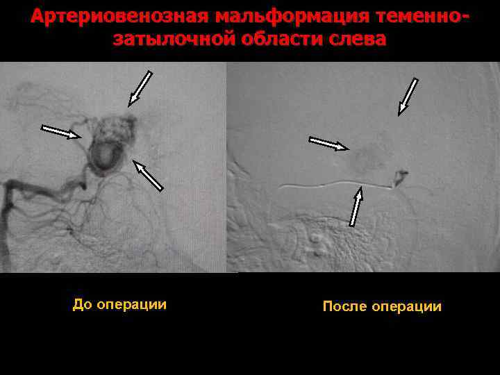 Артериовенозная мальформация теменнозатылочной области слева До операции После операции 