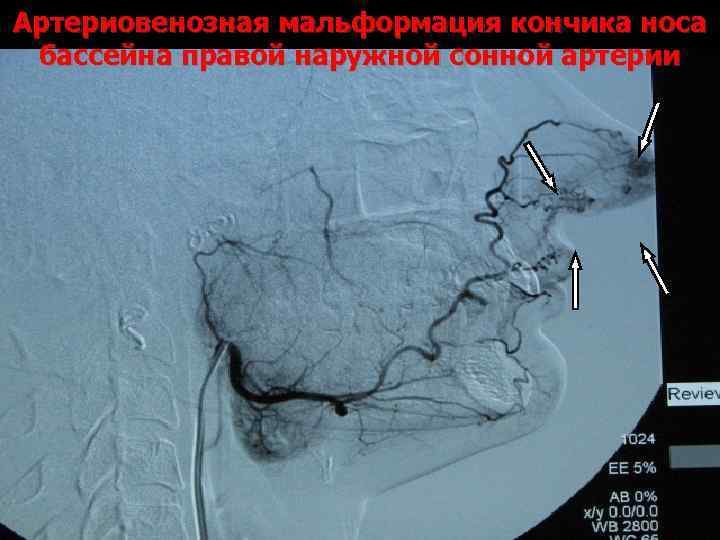 Артериовенозная мальформация кончика носа бассейна правой наружной сонной артерии 