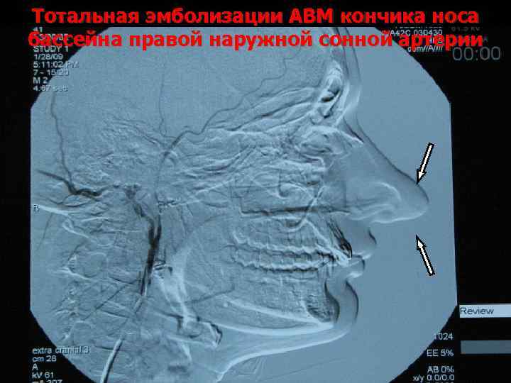 Тотальная эмболизации АВМ кончика носа бассейна правой наружной сонной артерии 