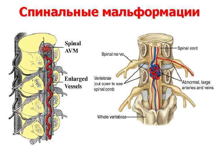 Спинальные мальформации 