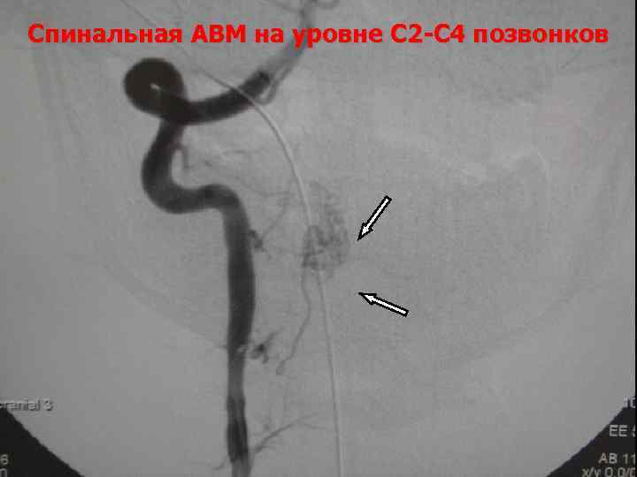 Спинальная АВМ на уровне С 2 -С 4 позвонков 