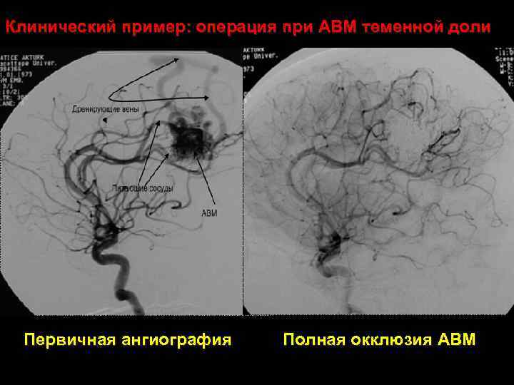 Клинический пример: операция при АВМ теменной доли Первичная ангиография Полная окклюзия АВМ 