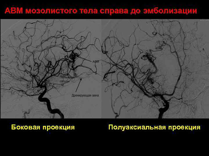 АВМ мозолистого тела справа до эмболизации Боковая проекция Полуаксиальная проекция 