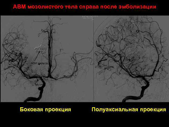 АВМ мозолистого тела справа после эмболизации Боковая проекция Полуаксиальная проекция 