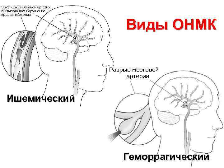 Виды ОНМК Ишемический Геморрагический 