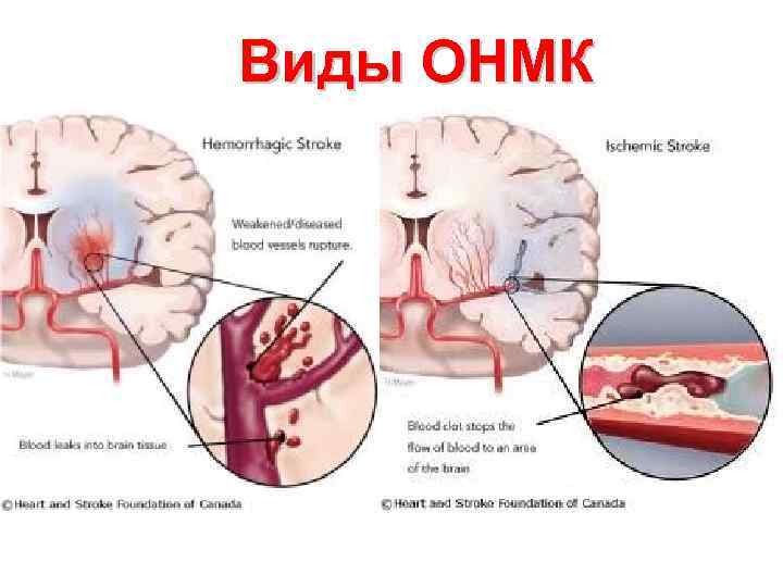 Виды ОНМК 