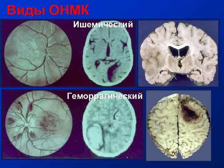 Виды ОНМК Ишемический Геморрагический 