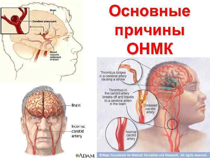 Основные причины ОНМК 