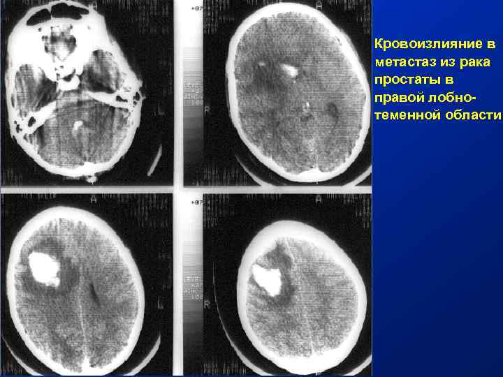 Кровоизлияние в метастаз из рака простаты в правой лобнотеменной области 