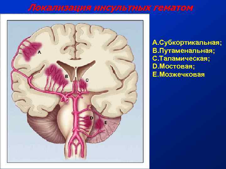 Локализация инсультных гематом A. Субкортикальная; B. Путаменальная; C. Таламическая; D. Мостовая; E. Мозжечковая 