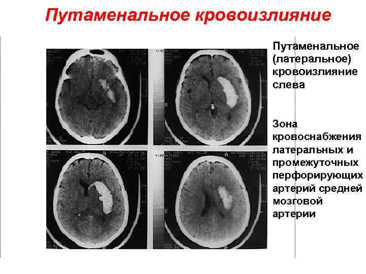 Путаменальное кровоизлияние Путаменальное (латеральное) кровоизлияние слева Зона кровоснабжения латеральных и промежуточных перфорирующих артерий средней