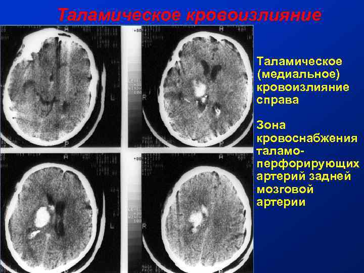 Таламическое кровоизлияние Таламическое (медиальное) кровоизлияние справа Зона кровоснабжения таламоперфорирующих артерий задней мозговой артерии 