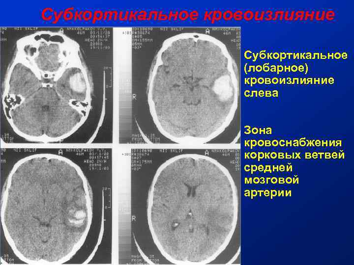 Субкортикальное кровоизлияние Субкортикальное (лобарное) кровоизлияние слева Зона кровоснабжения корковых ветвей средней мозговой артерии 