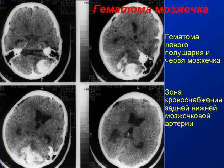 Гематома мозжечка Гематома левого полушария и червя мозжечка Зона кровоснабжения задней нижней мозжечковой артерии