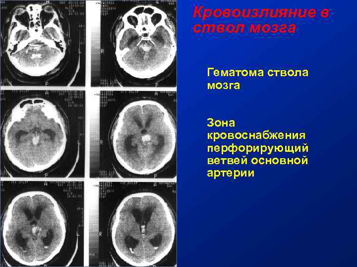 Гематома мозга операция