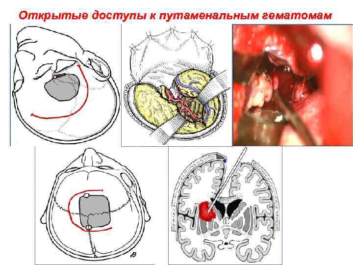 Открытые доступы к путаменальным гематомам 