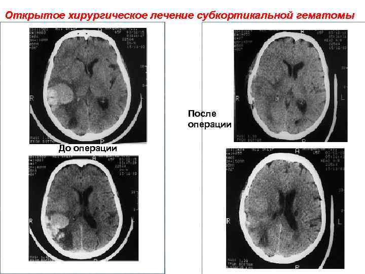 Открытое хирургическое лечение субкортикальной гематомы После операции До операции 