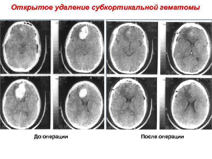 Открытое удаление субкортикальной гематомы До операции После операции 