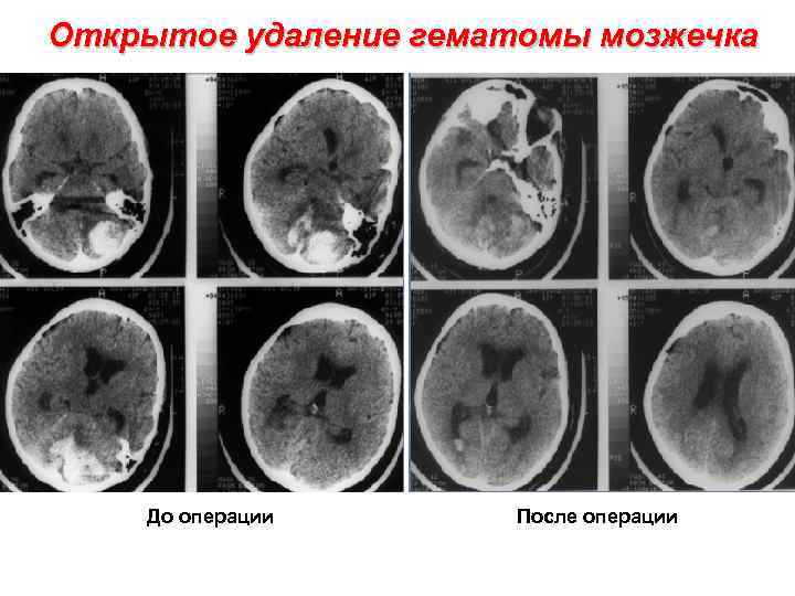 Открытое удаление гематомы мозжечка До операции После операции 