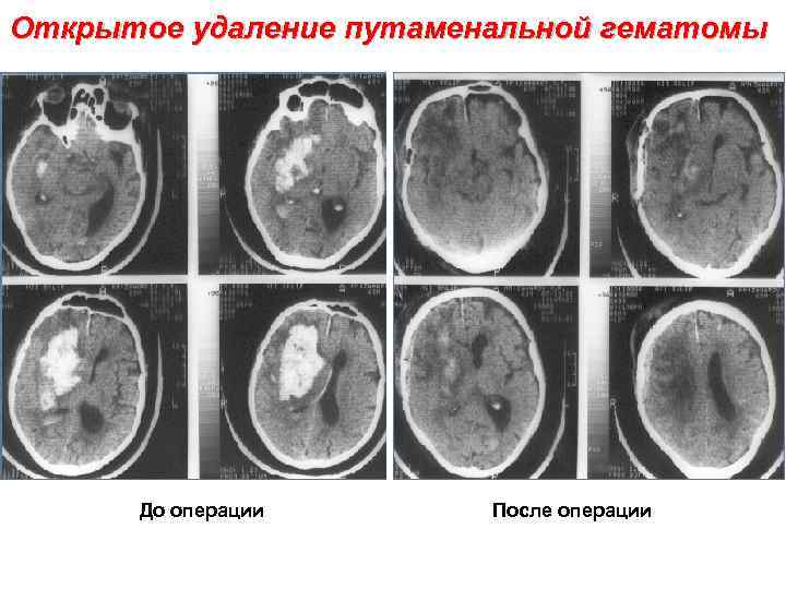 Открытое удаление путаменальной гематомы До операции После операции 
