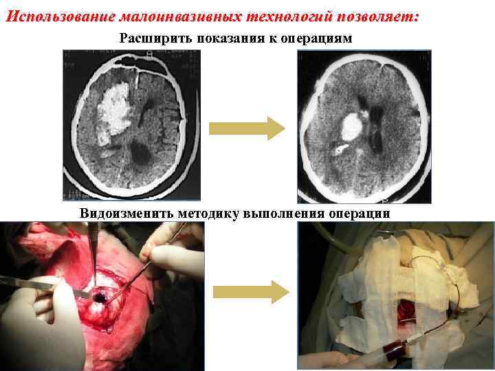 Использование малоинвазивных технологий позволяет: Расширить показания к операциям Видоизменить методику выполнения операции 