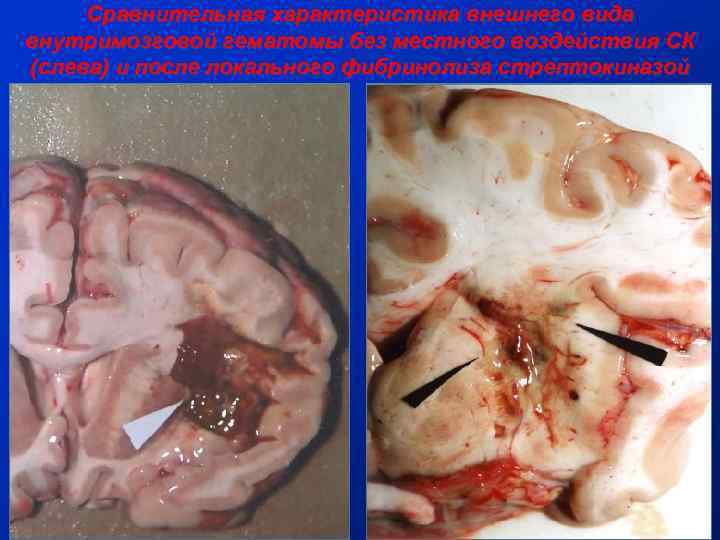 Сравнительная характеристика внешнего вида внутримозговой гематомы без местного воздействия СК (слева) и после локального